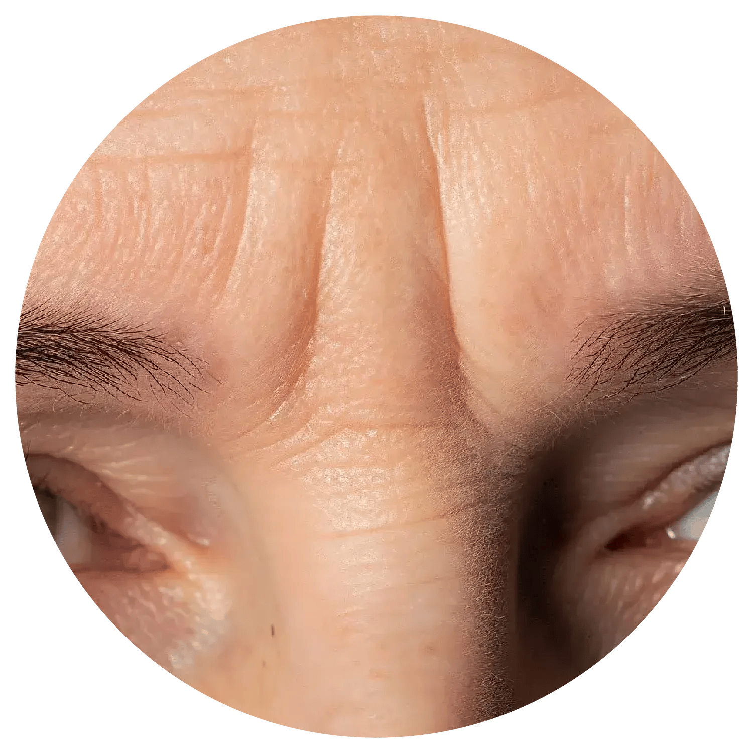 Glabellar lines treatment process at Toronto medical spa - root causes and development
